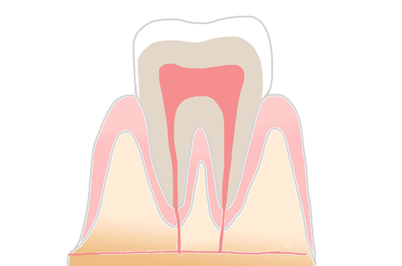 C0（初期の虫歯）の症状