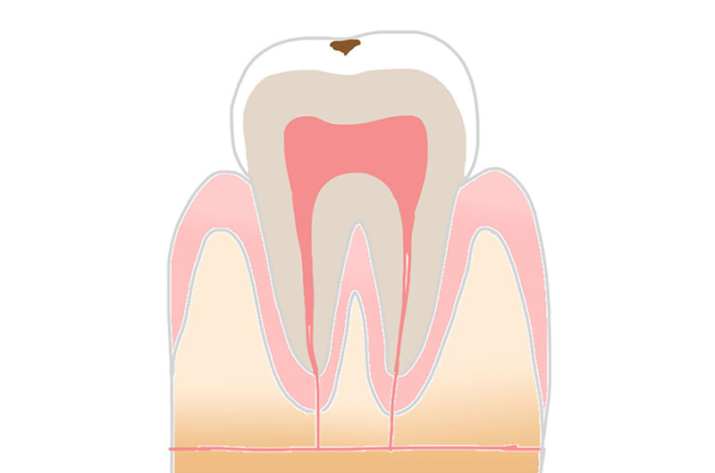 C1（エナメル質の虫歯）の症状