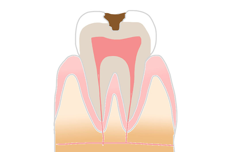 C2（象牙質の虫歯）の症状