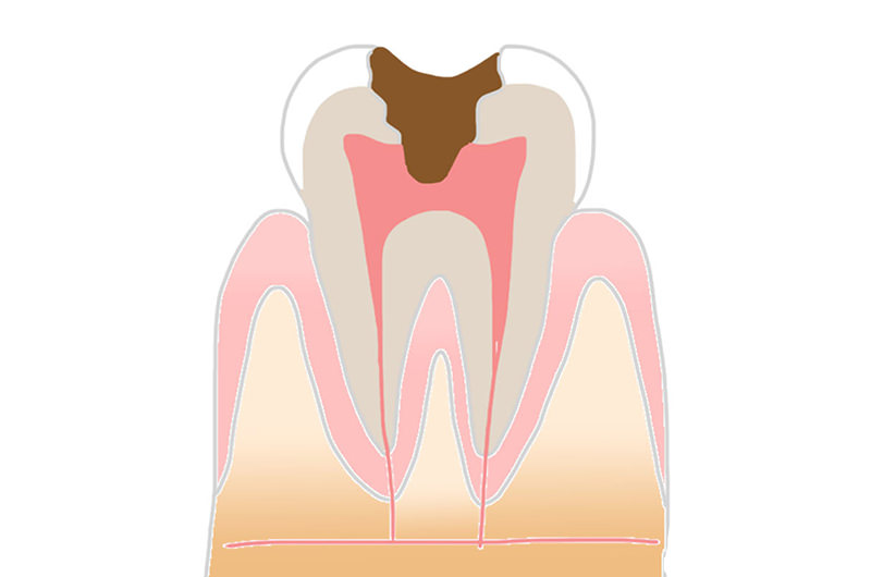 C3（神経まで達した虫歯）の症状