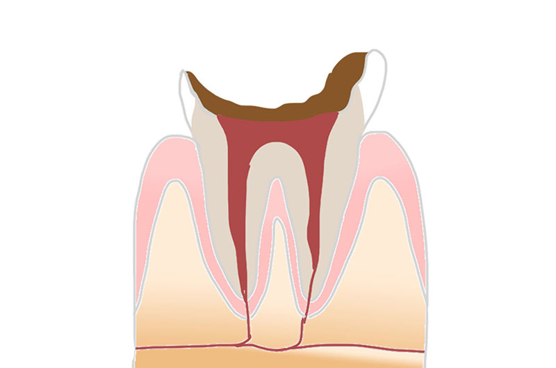 C4（歯根まで達した虫歯）の症状