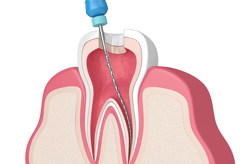 根管治療とは